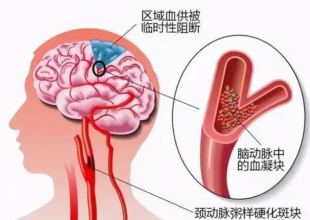 經顱多普勒儀器廠家帶您了解腦動脈硬化的臨床表現