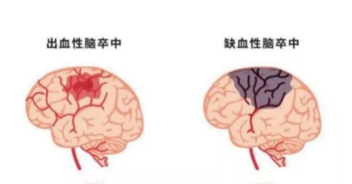 「腦部聽診器」彩色經顱多普勒檢測顱內動脈